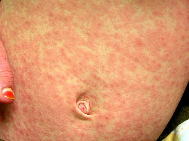 عکس بیماری سرخک در کودکان