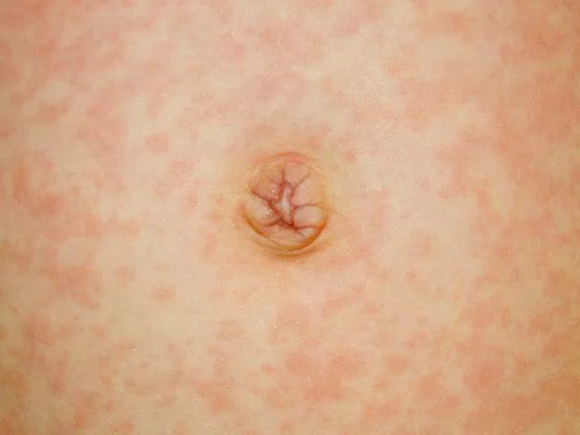 عکس بیماری روزئولا در کودکان