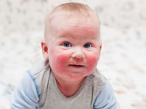 درماتیت آتوپیک در کودکان - اگزما در کودکان