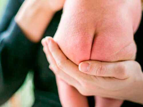 راش پوشک در نوزادان (Diaper Rash)