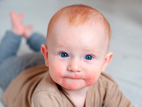 راش پوستی ناشی از آب دهان - راش بزاق