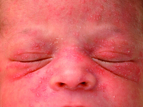 حساسیت پوستی اریتم توکسیکوم در نوزادان (Erythema Toxicum)