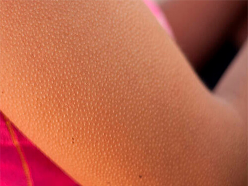 کراتوز پیلار یا بیماری پوست مرغی