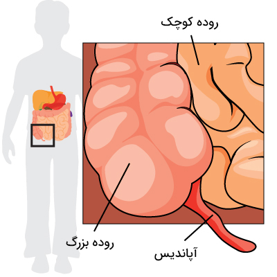 آپاندیس در کودکان