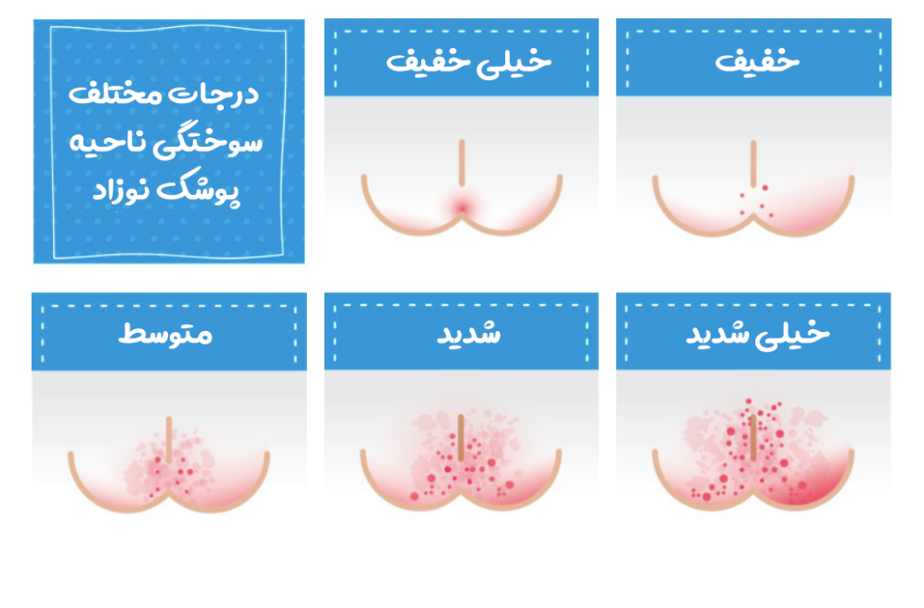 درجات مختلف سوختگی پا در نوزادان