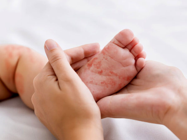 عکس سرخک در کودکان - کف پا
