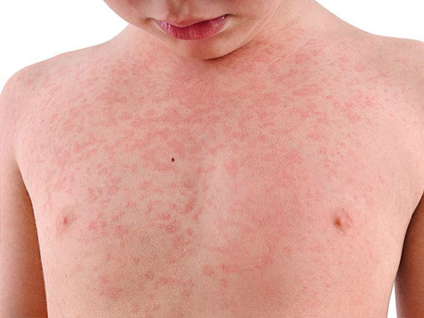 عکس سرخک در کودکان - ناحیه سینه