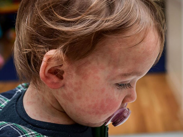 عکس سرخک در کودکان - صورت