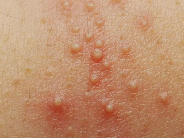 شکل جوش‌ های سرخک