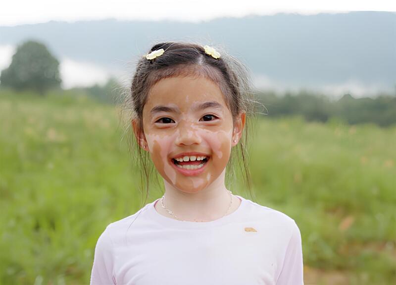 عکس پیسی موضعی در کودکان