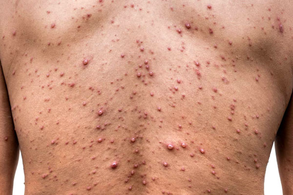 عکس آبله مرغان کودکان