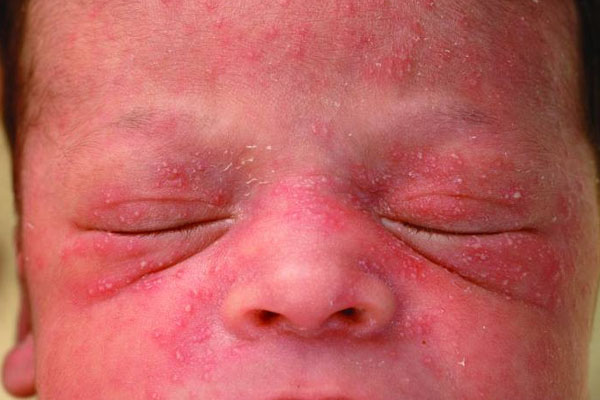 عکس اریتم توکسیکوم نوزادی