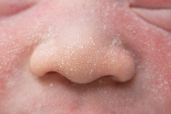 عکس میلیا در نوزادان