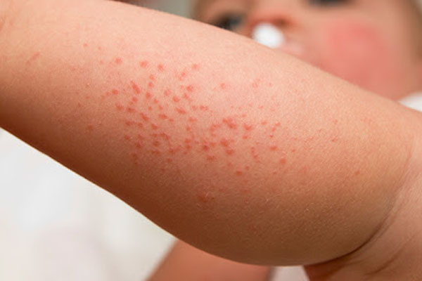 عکس جوش عرق سوز نوزاد