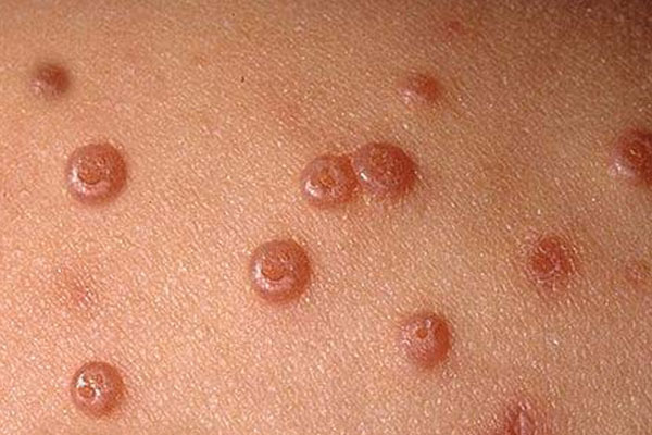 عکس مولوسکوم کانتوژیوزوم در کودکان