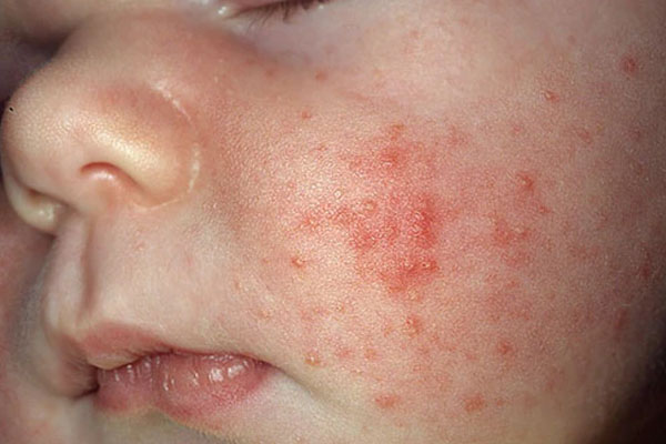 عکس آکنه پوستی نوزاد