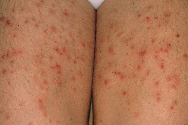 عکس فولیکولیت مو