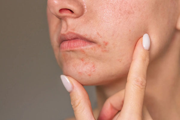 عکس درماتیت پریورال