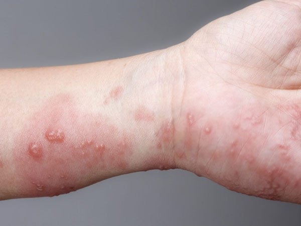 عکس گال در کودکان