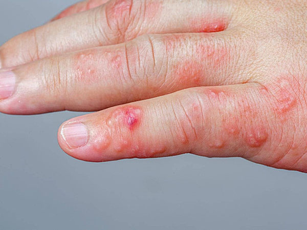 عکس گال در کودکان