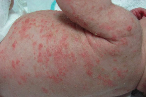 عکس گال در کودکان