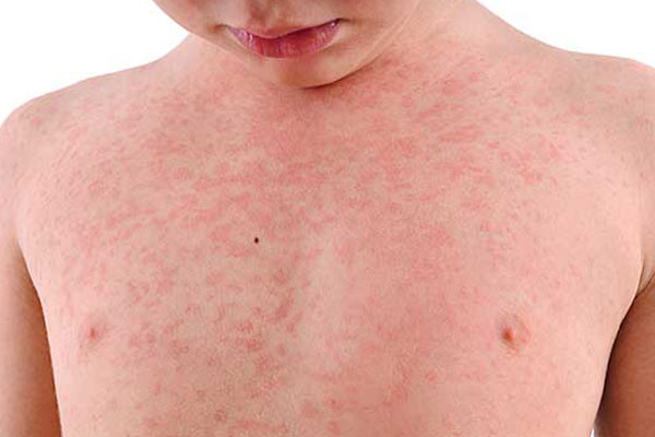 عکس جوش آلرژیک در کودکان